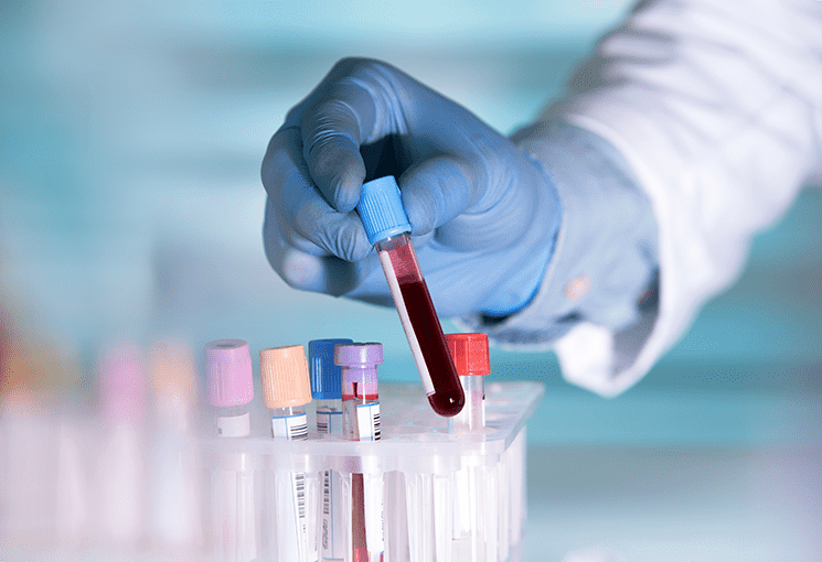 ASCO 2020: Blood Test Predicts Response to Prostate Cancer Treatment