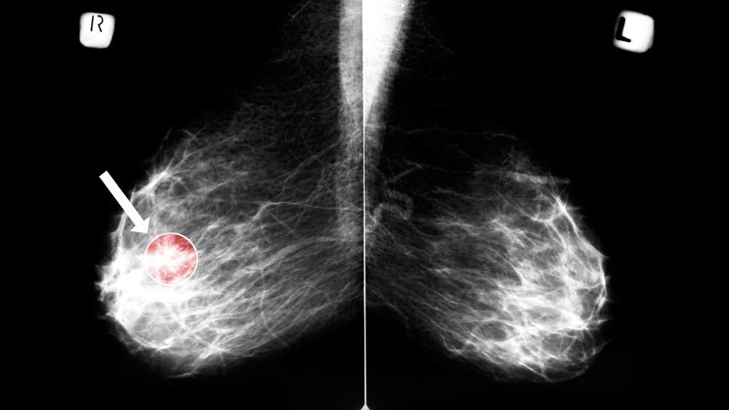 Mammography Cuts Risk for Fatal Breast Cancers: New Data
