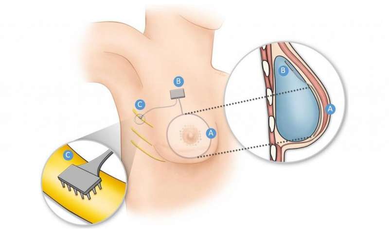 How researchers are restoring sensation via implant to breast cancer survivors